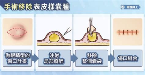 臉上有一顆凸起|臉上凸起「一粒」竟不是痘痘！醫揭「表皮樣囊腫」特。